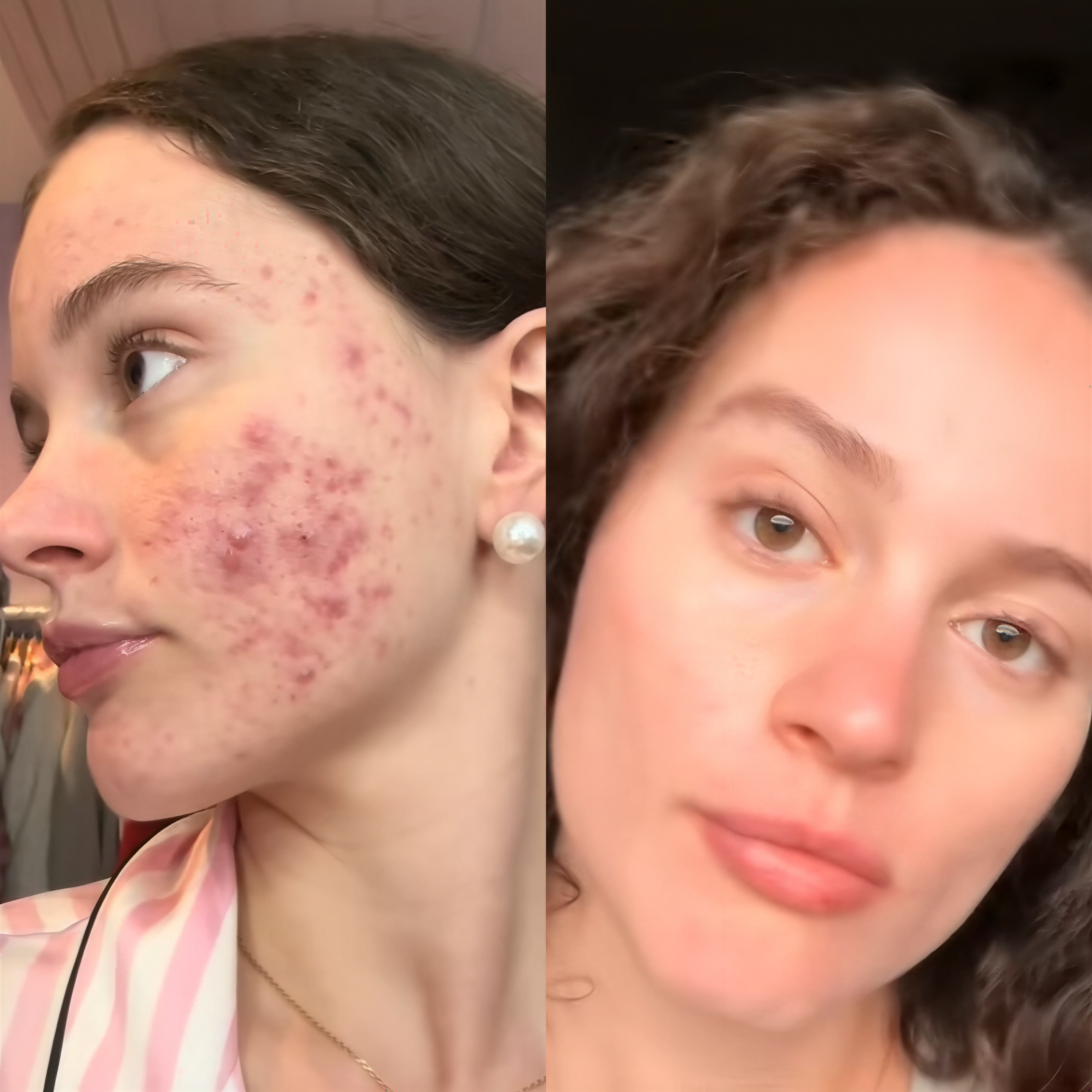 AcneClear Pro - Masque Anti-Acné