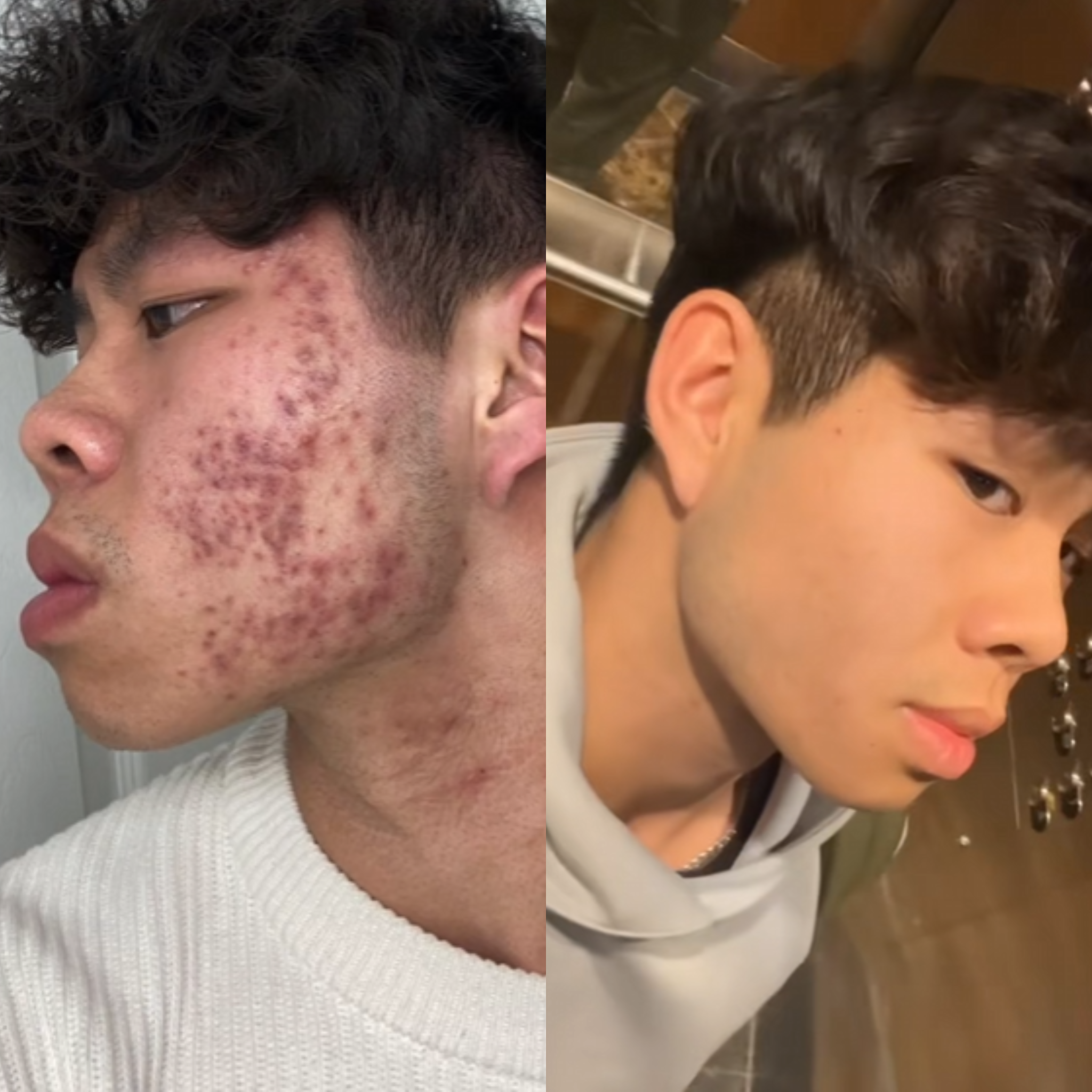 AcneClear Pro - Masque Anti-Acné