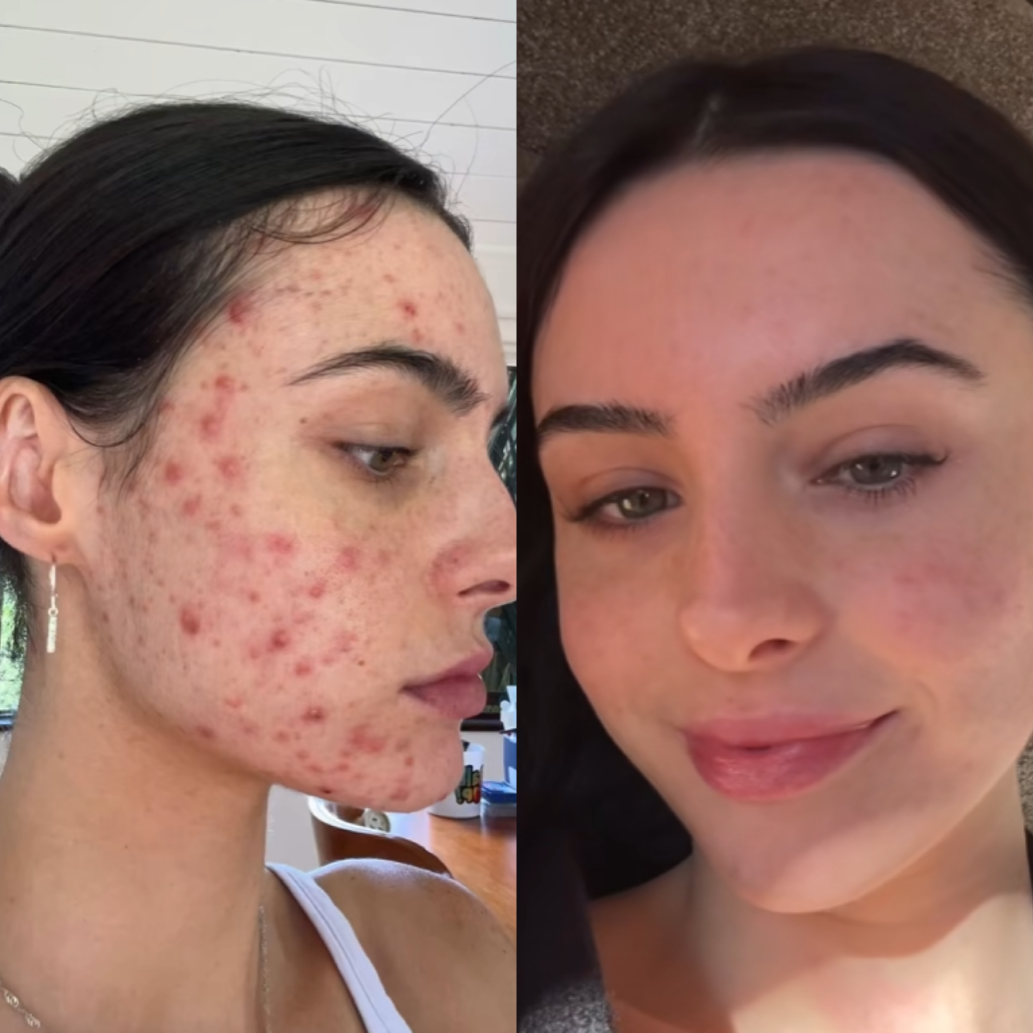 AcneClear Pro - Masque Anti-Acné